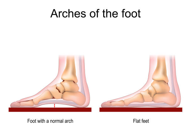 how to fix flat foot